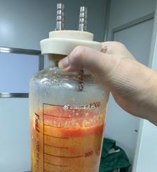 灌南水动力吸脂手术要做多久？
